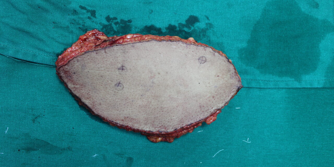 Microvascular Free Flap Reconstruction for Diabetic Foot Ulcers: A Limb Salvage Approach